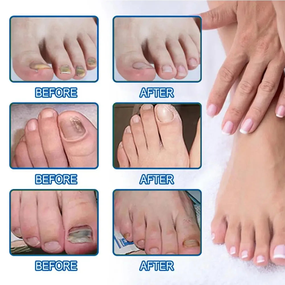 Discrete Herstelpleisters voor Schimmelnagels — foto 5